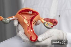 خطرات بارداری بعد از بستن لوله ها