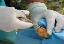 جراحی فرو رفتن ناخن در گوشت || پزشکت