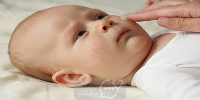 درمان بثورات گردن در نوزاد