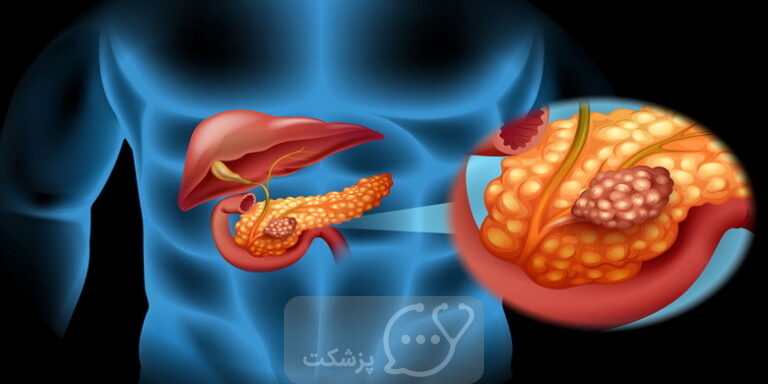 سرطان اثنی عشر || پزشکت