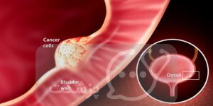 سرطان مثانه سطحی چیست؟ || پزشکت