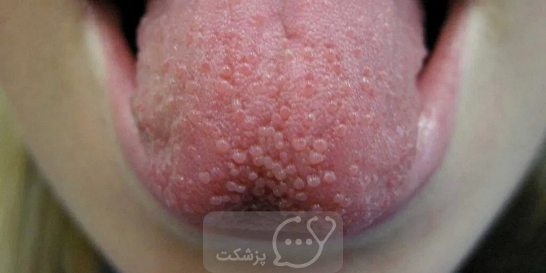 شایع ترین علل درد زبان || پزشکت