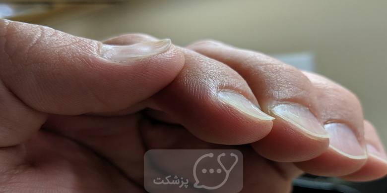 شایع ترین علل ناخن های قاشقی || پزشکت