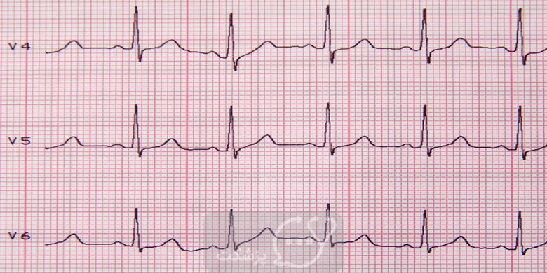 تغییرات ضربان قلب یا HRV || پزشکت