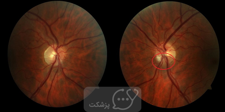 علائم چشمی ام اس || پزشکت