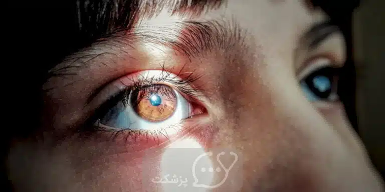 تجمع مایع پشت شبکیه | پزشکت