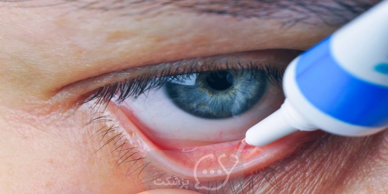 عوارض قطره چشمی فلورومتولون || پزشکت