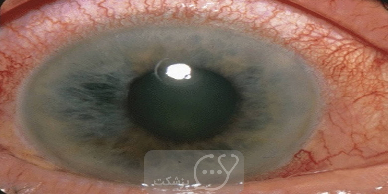 عوارض قطره چشمی فلورومتولون || پزشکت