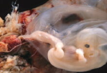 سقط جنین در سه ماهه اول و دوم || پزشکت