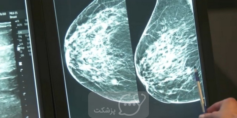 سینتی ماموگرافی چیست؟ || پزشکت