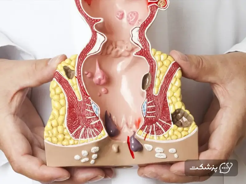 هموروئید