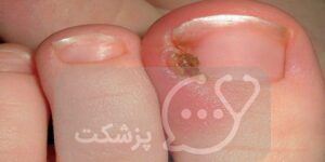 رشد دوباره ناخن پا || پزشکت