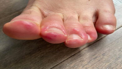 علل قرمزی انگشتان پا || پزشکت