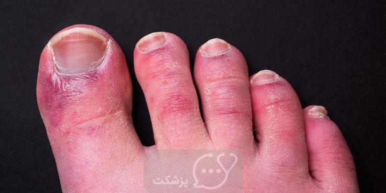 علل قرمزی انگشتان پا || پزشکت