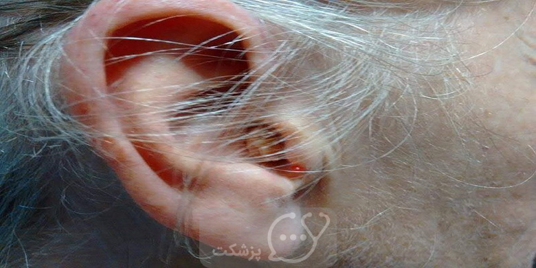 قارچ گوش چیست؟ || پزشکت