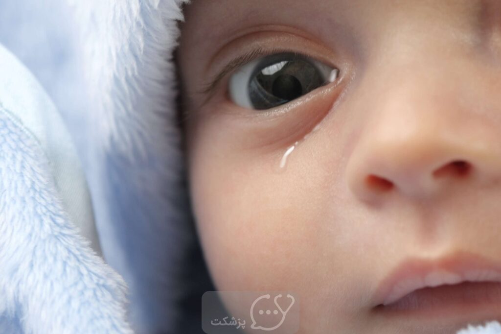 ترشح چشمی در نوزادان|| پزشکت