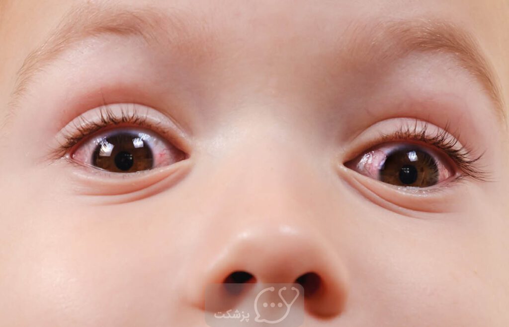 چشم صورتی در نوزاد|| پزشکت