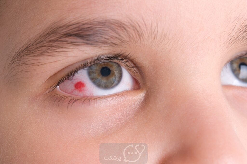خونریزی چشم|| پزشکت