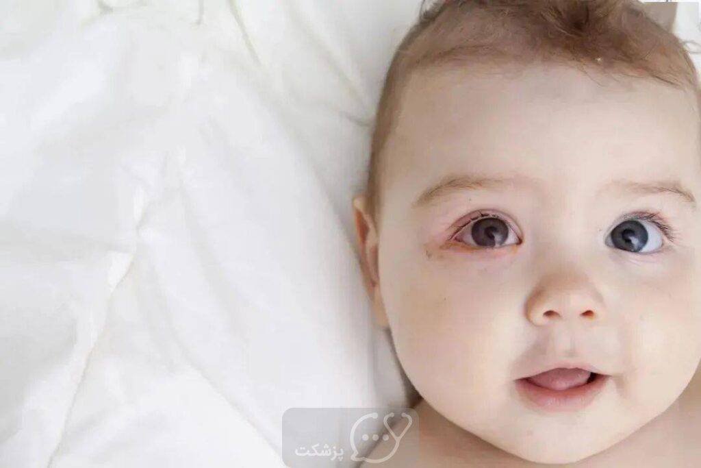 چشم صوردتی در نوزادان || پزشکت