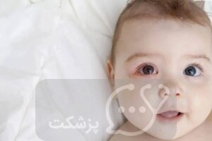 چشم صوردتی در نوزادان || پزشکت