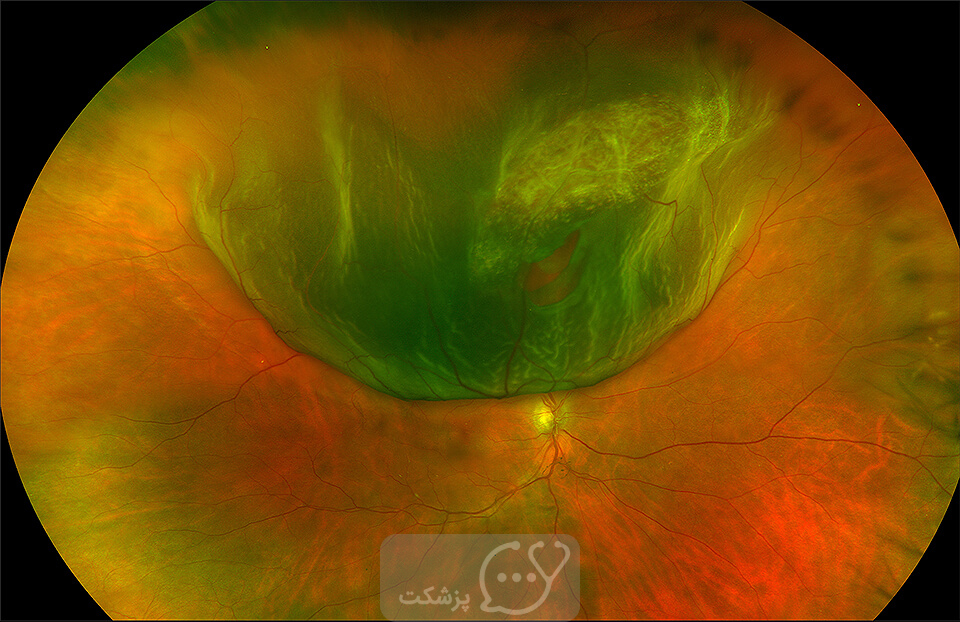 پارگی شبکیه چشم || پزشکت