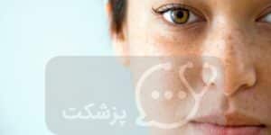 افزایش و کاهش ملانین در بدن | پزشکت