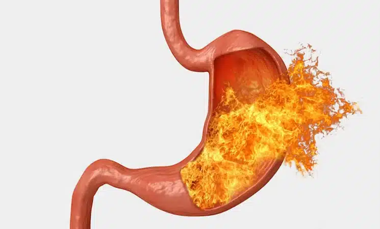 رفلاکس اسید معده | پزشکت