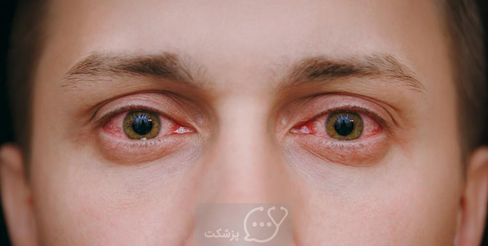 قرمزی چشم || پزشکت