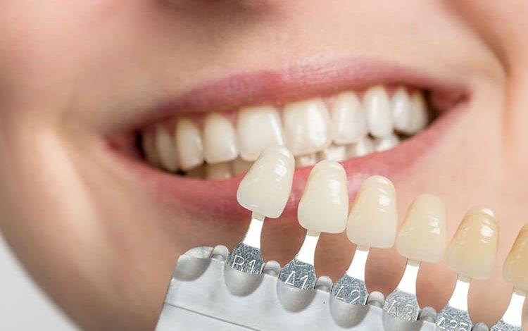 باندینگ دندان || پزشکت