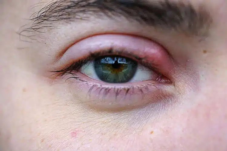 گل مژه || پزشکت