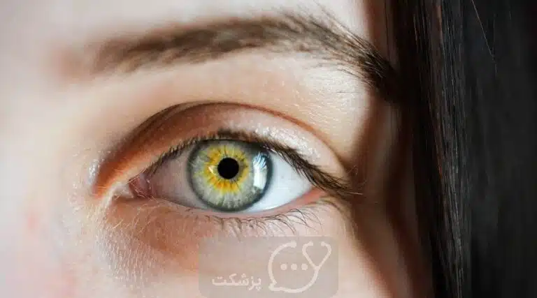 لکه سفید چشم | پزشکت
