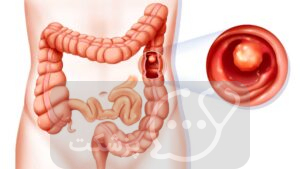کولیت عفونی || پزشکت