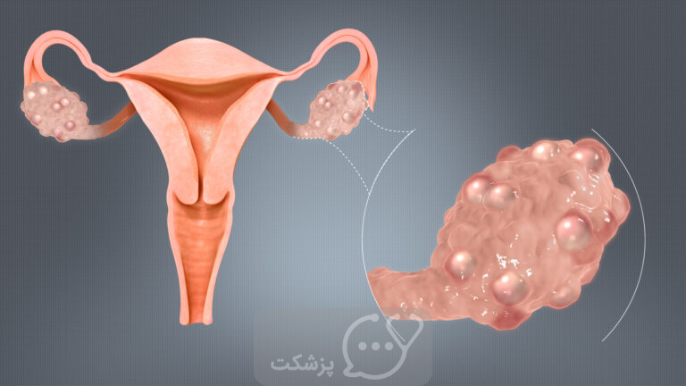 تخمدان پلی‌ کیستیک|| پزشکت