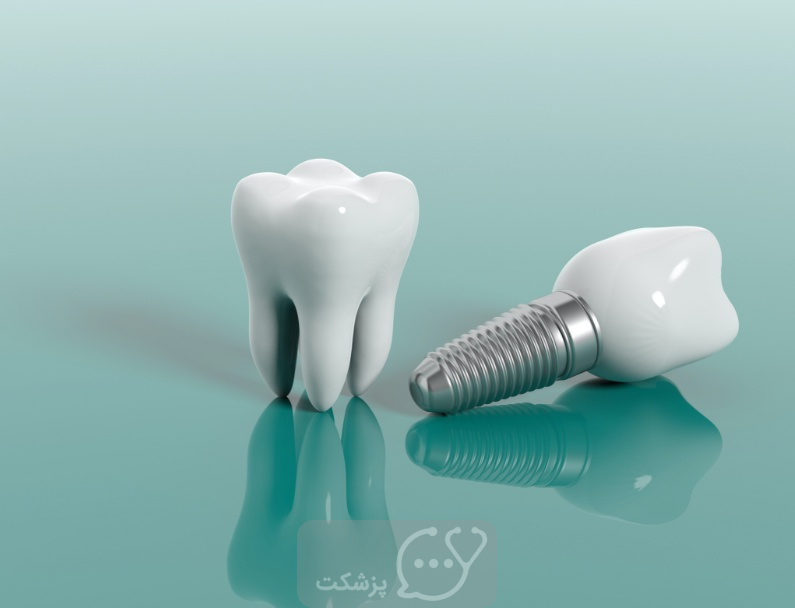 جراحی ایملنت دندان || پزشکت