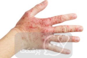 بیماری HSP | پزشکت