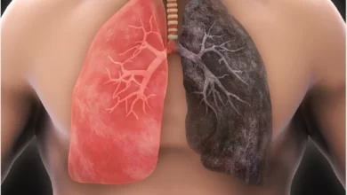 ریه افراد سیگاری || پزشکت