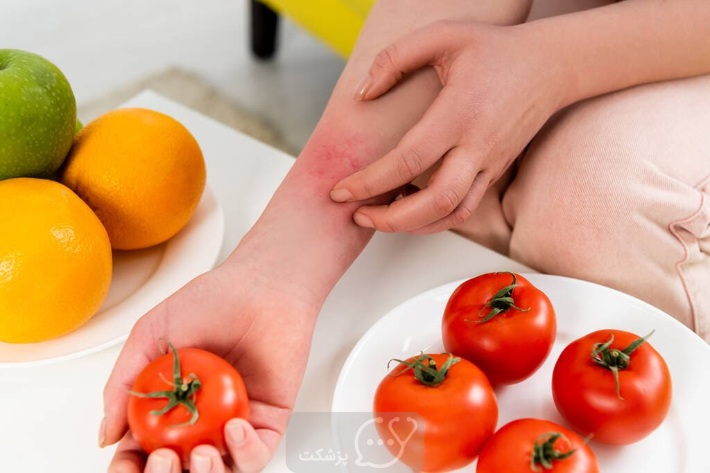 آلرژی به گوجه فرنگی || پزشکت