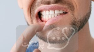 بی حسی دهان | پزشکت