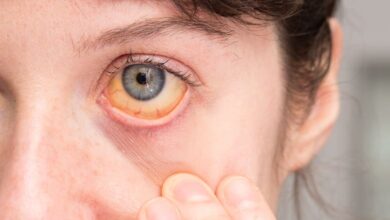 زردی چشم || پزشکت