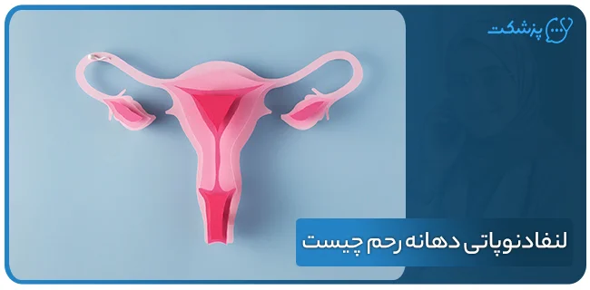 لنفادنوپاتی دهانه رحم چیست؟ | پزشکت