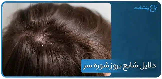 دلایل شایع بروز شوره سر | پزشکت