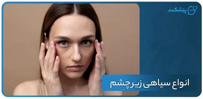 انواع سیاهی زیر چشم | پزشکت
