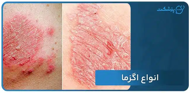 انواع اگزما | پزشکت