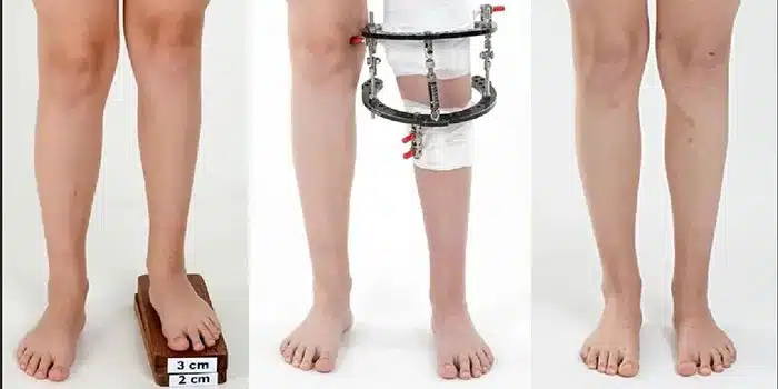 تجربه واقعی افرادی که جراحی افزایش قد رو انجام دادن