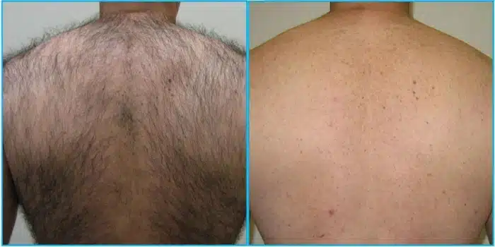 آیا لیزر موهای زائد تاثیر همیشگی دارد یا تبلیغات است؟