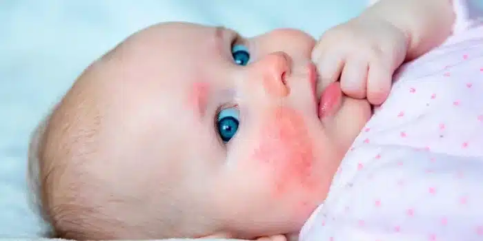 حساسیت به بادام زمینی باید از کودکی کنترل شود!