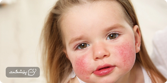 دکتر آنلاین کودکان برای آلرژی غذایی | پزشکت