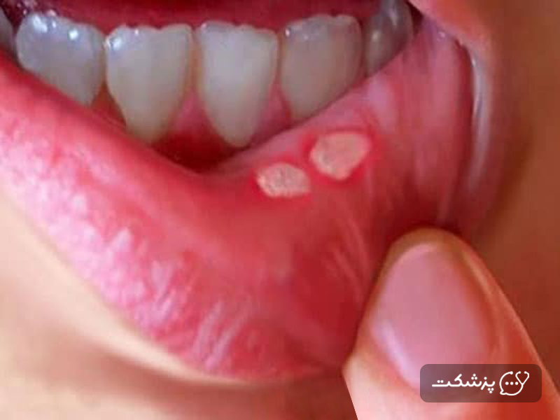 عفونتهای دهانی مرتبط با رابطه جنسی دهانی