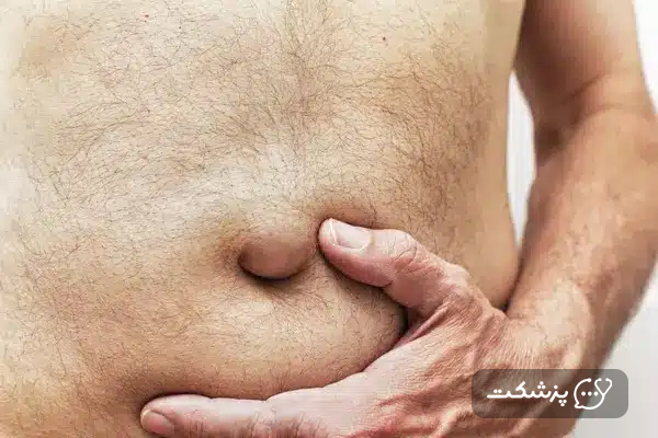 توده اطراف ناف