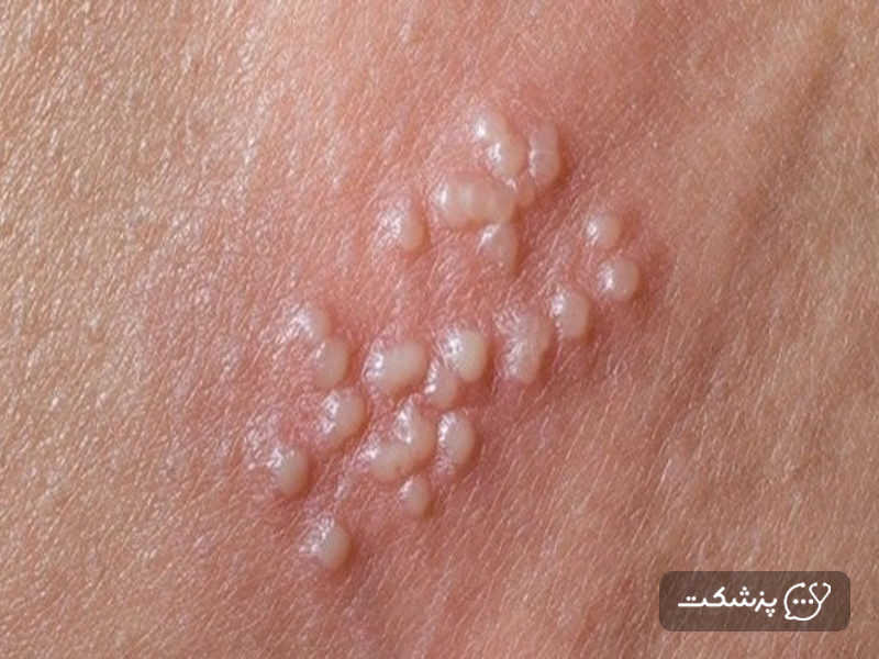 زگیل تناسلی